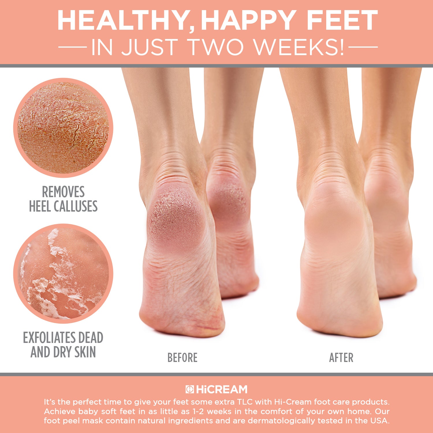 What Really Causes Cracked Heels (Part 1) | Blog | Gotham Footcare
